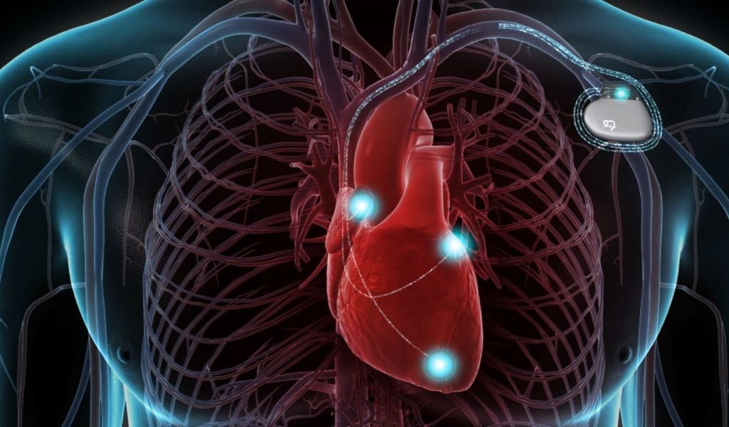 AICD Implantation