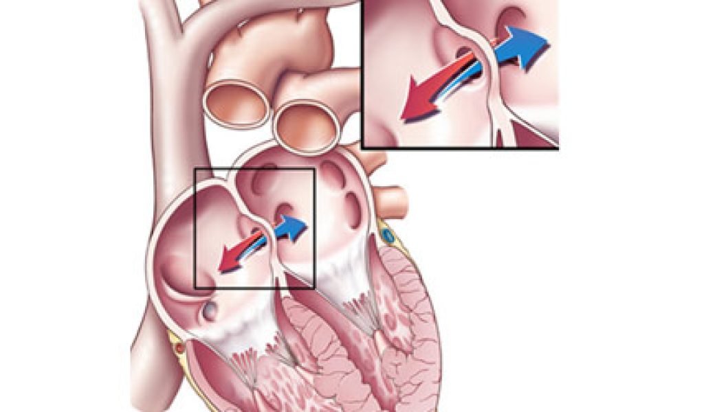 ASD Device Closure