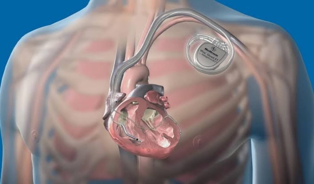 CRT Implantation