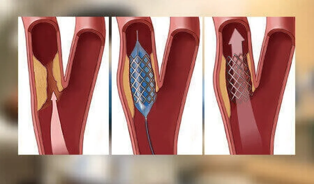 CTO Angioplasty