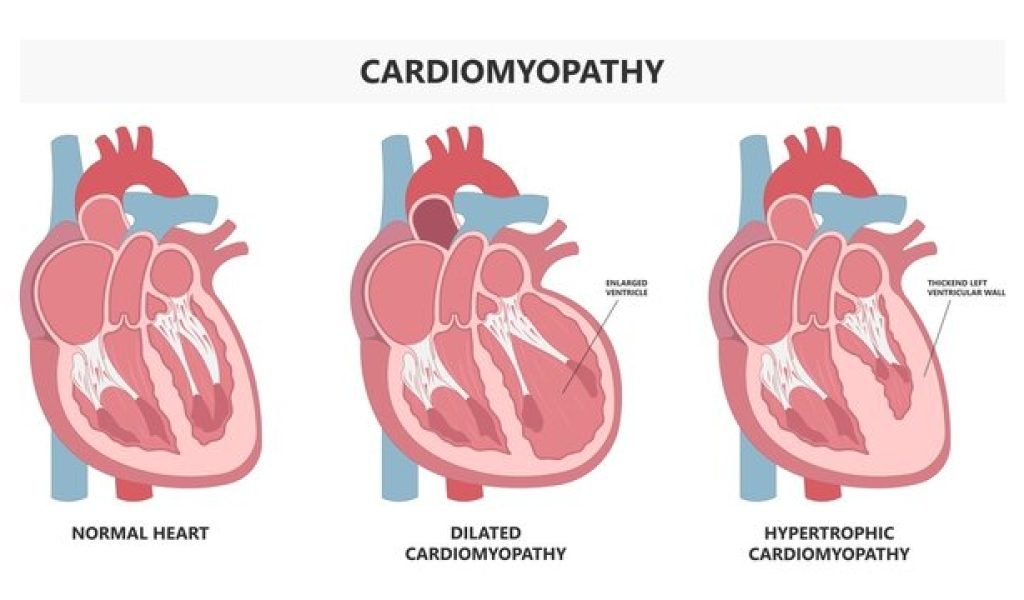 Cardiomyopathy