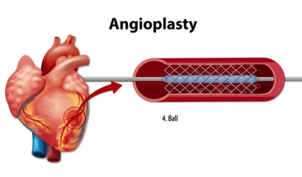 Coronary Angioplasty