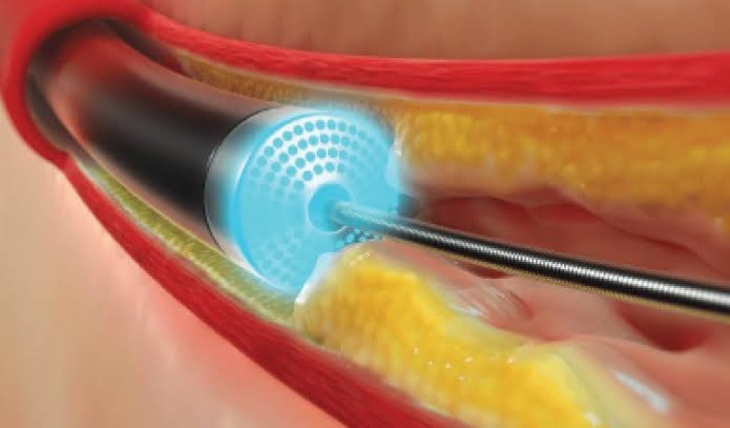 Laser Angioplasty
