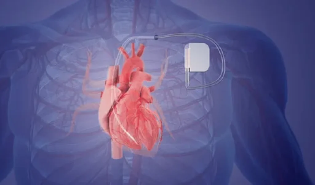 Pacemaker Implantation