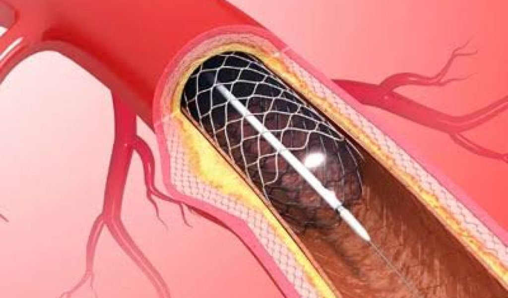 Primary Angioplasty