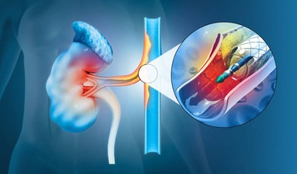 Renal Angioplasty