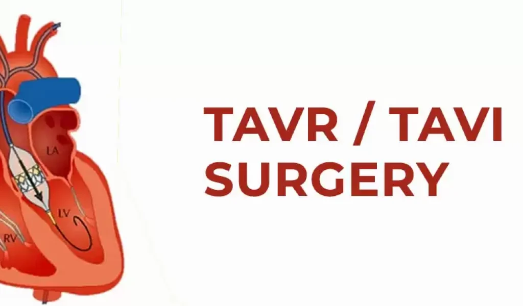 TAVI TAVR